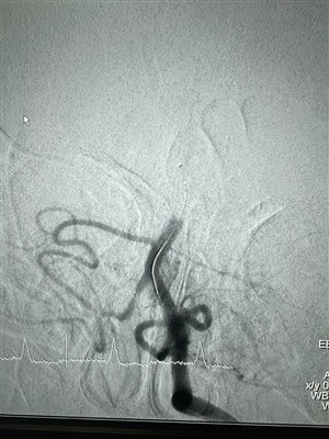 Μια νέα θήκη για το Dredger Stent Retriever